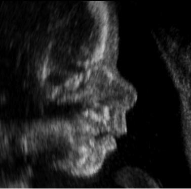 Perfil fetal em imagem de ultrassonografia obstétrica